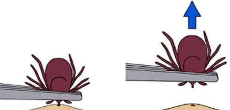 How to remove a tick (Image: Centers for Disease Control)