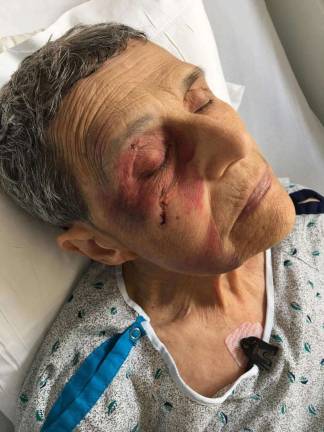 Mikki Weiss shared this photo taken of herself in the hospital in 2016, after breaking her eye socket and several fingers when she passed out in the middle of the night. &quot;This represents what can happen when one lives with tick-borne diseases,&quot; she said.